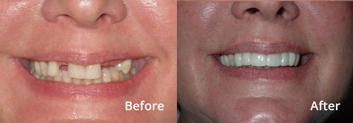 Cheri Skalicky Before and After: Replacement of missing teeth with Implants, Upper Anterior Cosmetics