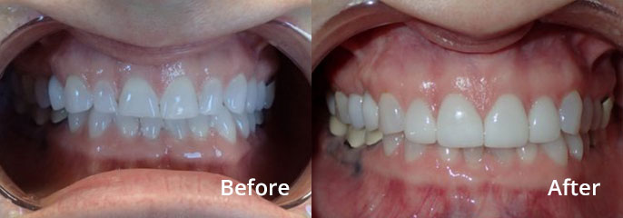 Shantell Cramer Before and After: Upper Anterior Porcelain Veneers
