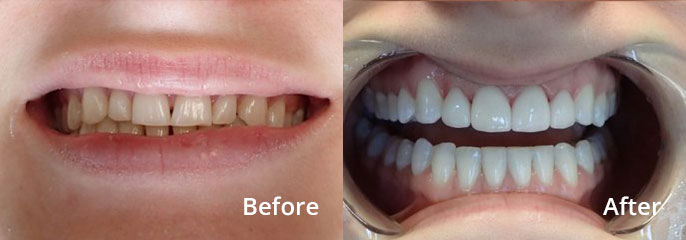 Zoe Cramer Before and After: Upper Anterior Porcelain Veneers, Lower Space Closure