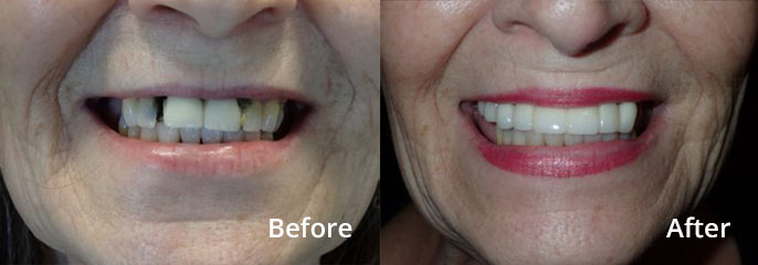Pam Harris Before and After: Upper Right Implants, Upper Anterior Bridge