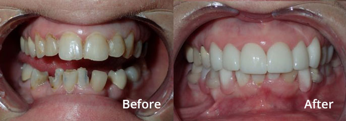 Tanya Butorac Before and After: Upper Anterior Crowns, Lower repair of teeth with a new Partial to replace missing