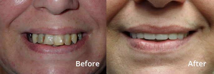 April Hansen Before and After: Upper Horseshoe Denture, Implant Retained