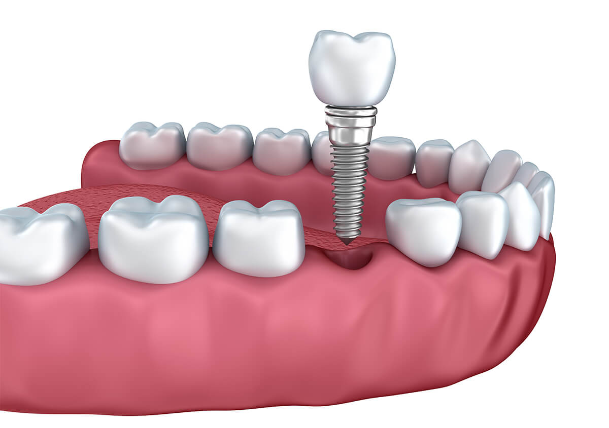 Teeth Implants Dentist in Maple Grove MN Area