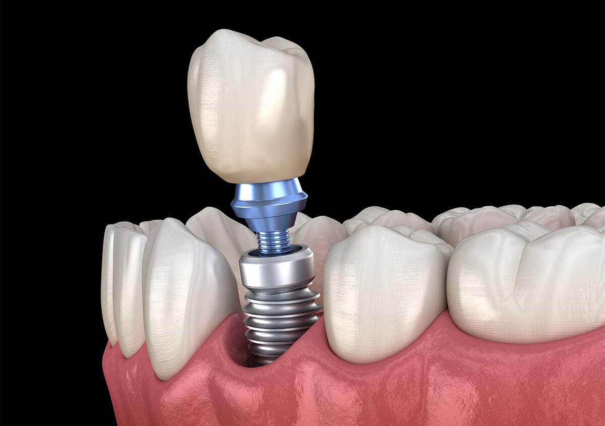How Long Dental Implants Last in Maple Grove MN Area