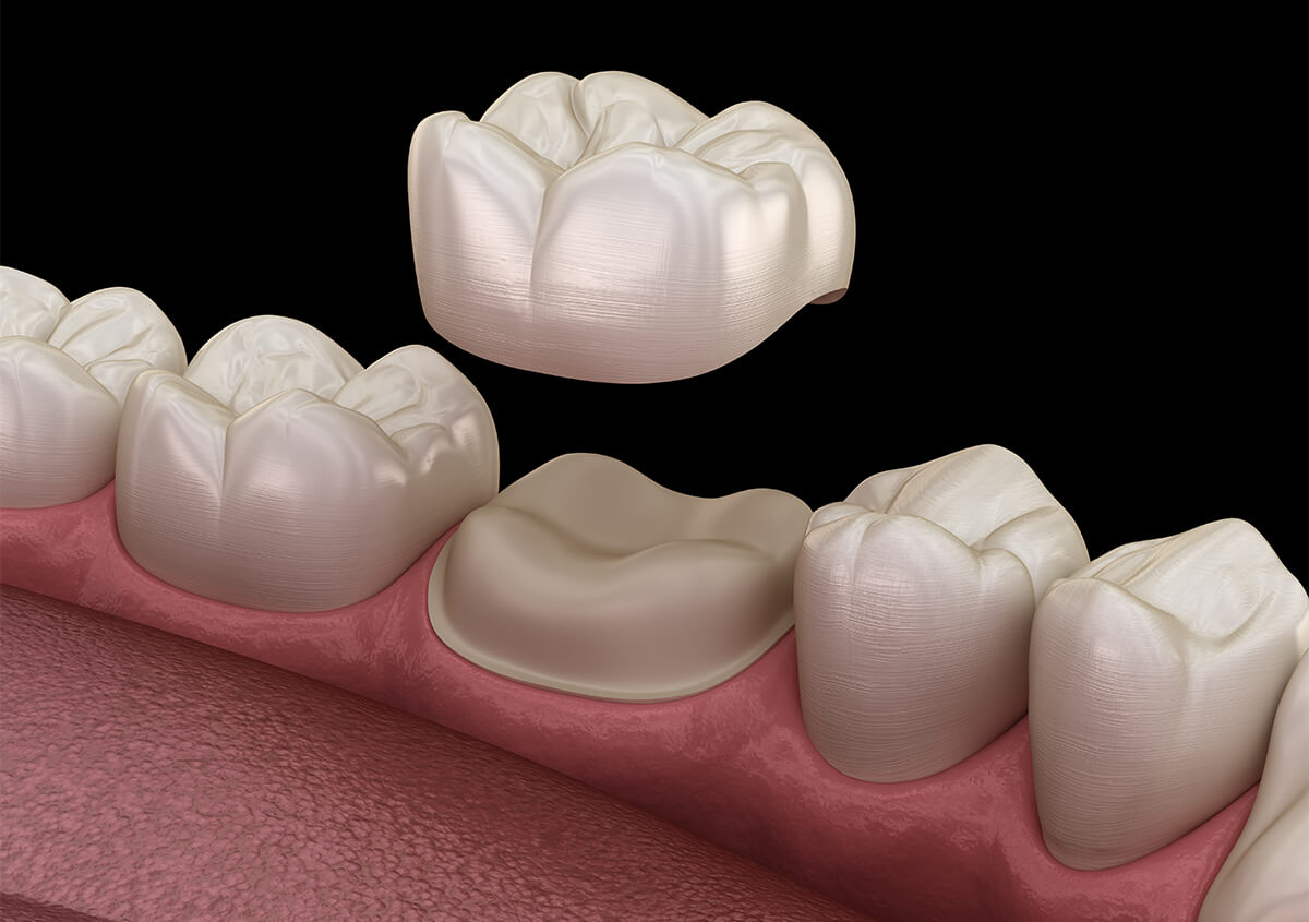 CEREC One-visit Porcelain Crowns in Maple Grove MN Area